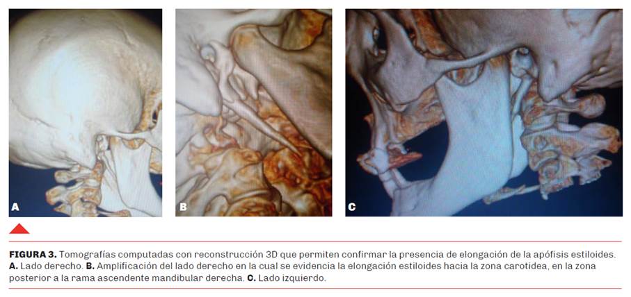 Vista de Actualización sobre el Síndrome de Eagle y sus Complicaciones  Neurocardiológicas